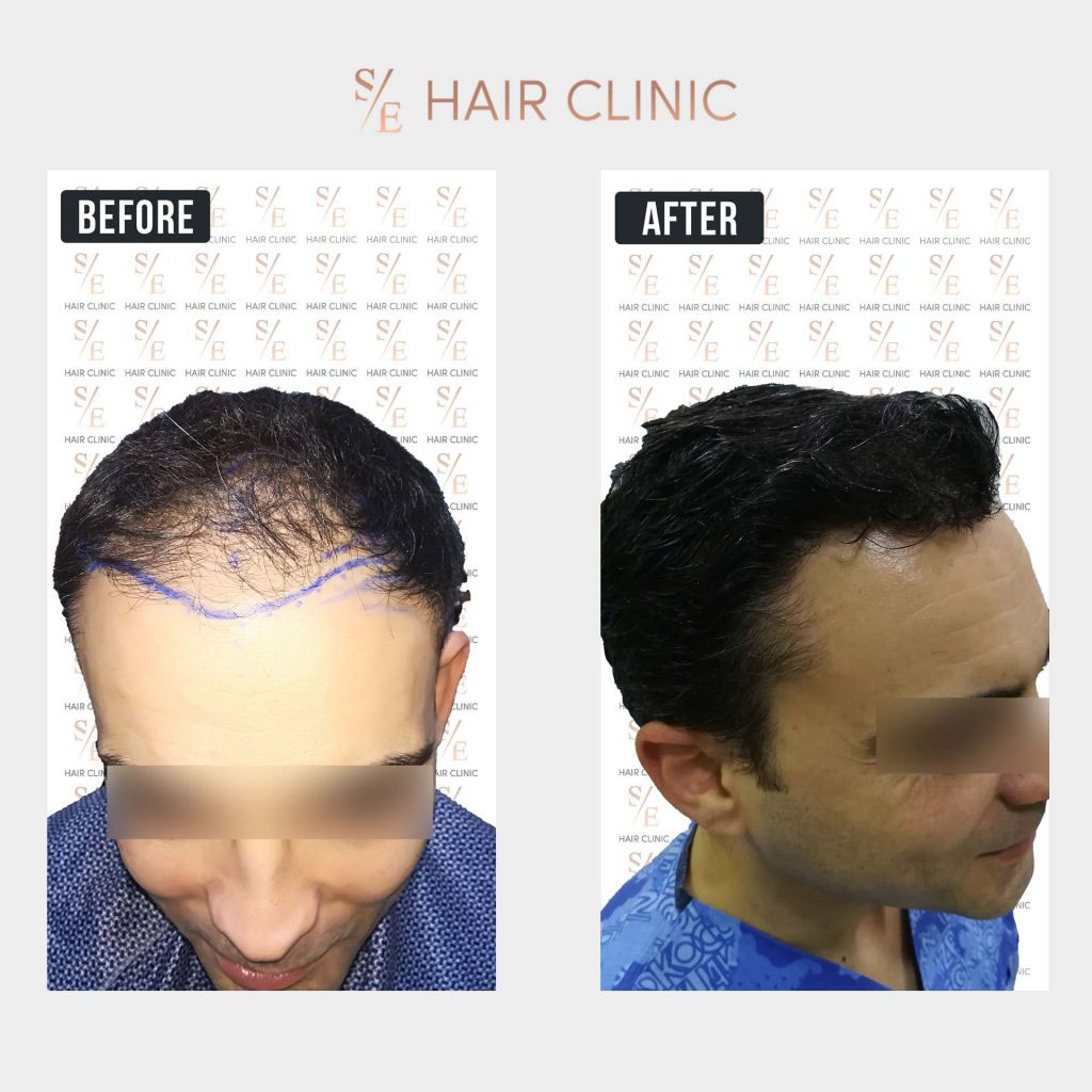 Before & After Images - SE Hair Clinic - Hair Transplant in Antalya Turkey