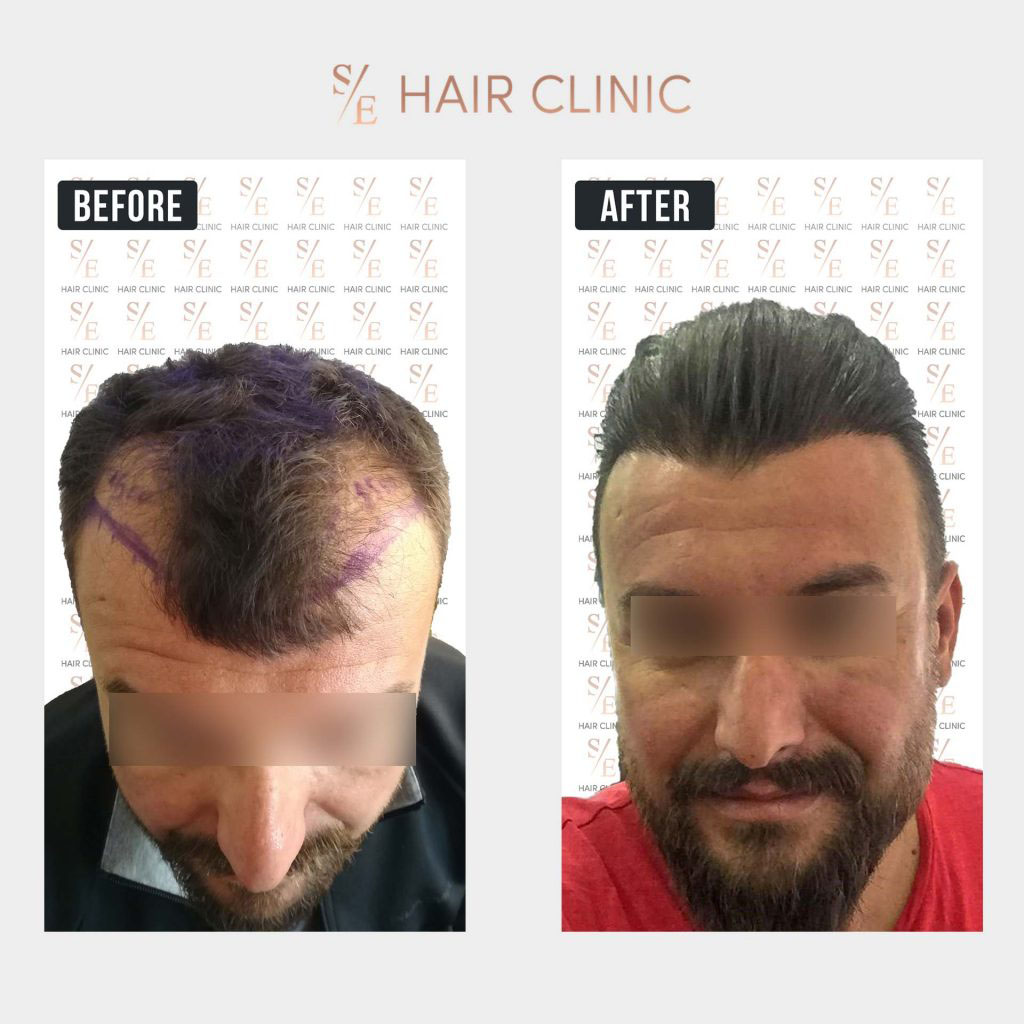 Before & After Images - SE Hair Clinic - Hair Transplant in Antalya Turkey
